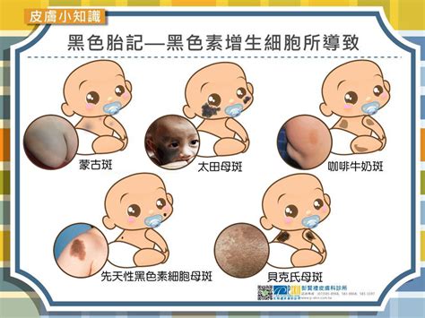 胎記位置|認識胎記的種類與治療照顧